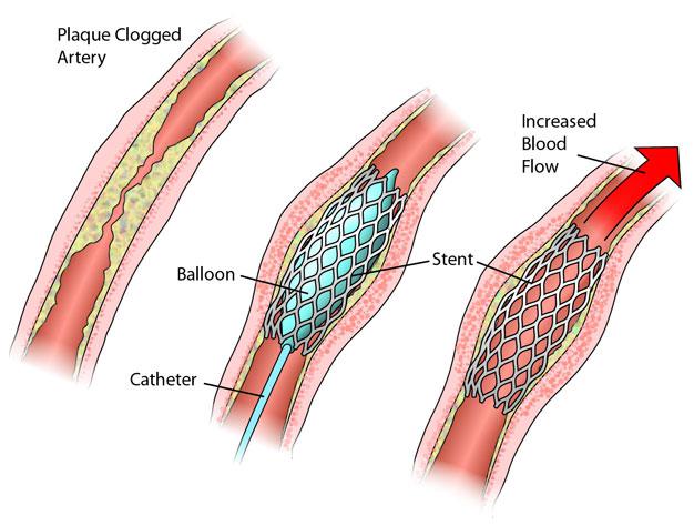 stent 